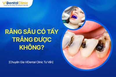 Răng Sâu Có Tẩy Trắng Được Không? Giải Đáp Từ Chuyên Gia