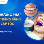 Top 17 Cách Tẩy Trắng Răng Cấp Tốc Đừng Bỏ Qua