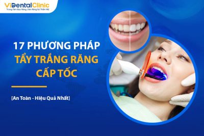 Top 17 Cách Tẩy Trắng Răng Cấp Tốc Đừng Bỏ Qua