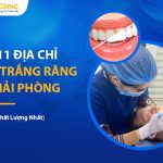 Gợi Ý 10 Địa Chỉ Tẩy Trắng Răng Hải Phòng Uy Tín, An Toàn