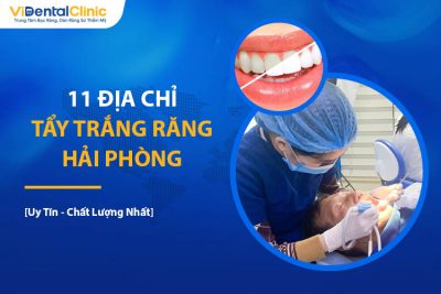 Gợi Ý 10 Địa Chỉ Tẩy Trắng Răng Hải Phòng Uy Tín, An Toàn