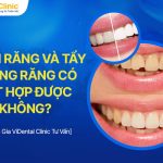 Trám Răng Và Tẩy Trắng Răng Có Kết Hợp Được Không?