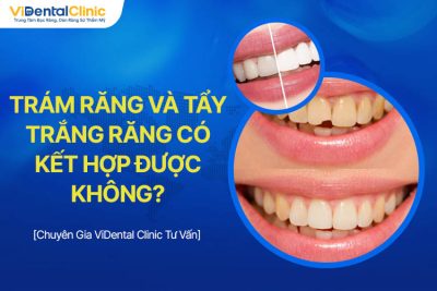 Trám Răng Và Tẩy Trắng Răng Có Kết Hợp Được Không?