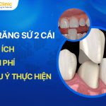 Bọc Răng Sứ 2 Cái Khi Nào? Chi Phí Và Lưu Ý Thực Hiện