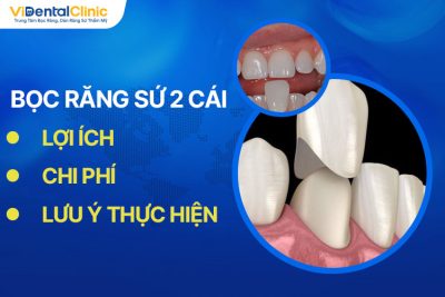 Bọc Răng Sứ 2 Cái Khi Nào? Chi Phí Và Lưu Ý Thực Hiện