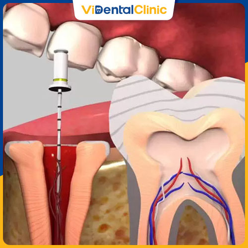 Bọc răng sứ sau khi điều trị tủy mang đến nhiều lợi ích