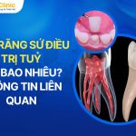 Bọc Răng Sứ Điều Trị Tủy Giá Bao Nhiêu? Thông Tin Liên QuanBọc Răng Sứ Điều Trị Tủy Giá Bao Nhiêu? Thông Tin Liên Quan