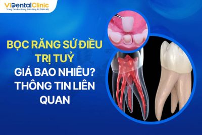 Bọc Răng Sứ Điều Trị Tủy Giá Bao Nhiêu? Thông Tin Liên QuanBọc Răng Sứ Điều Trị Tủy Giá Bao Nhiêu? Thông Tin Liên Quan