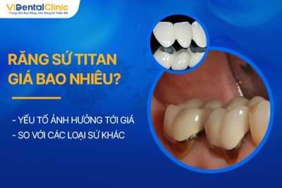 Răng Sứ Titan Giá Bao Nhiêu? Bảng Giá Chi Tiết Tại Các Nha Khoa Uy Tín