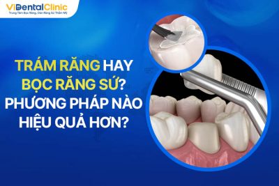 Nên Trám Răng Hay Bọc Răng Sứ? Chuyên Gia Giải Đáp