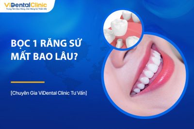 Bọc 1 Răng Sứ Mất Bao Lâu? Quy Trình Và Thời Gian Thực Hiện 