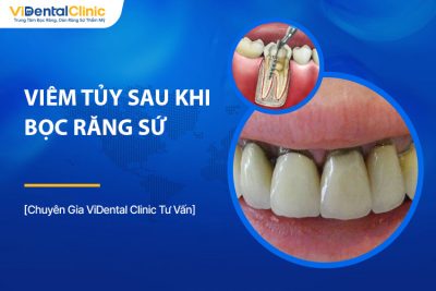 Viêm Tủy Sau Khi Bọc Răng Sứ: Nguyên Nhân, Cách Điều Trị